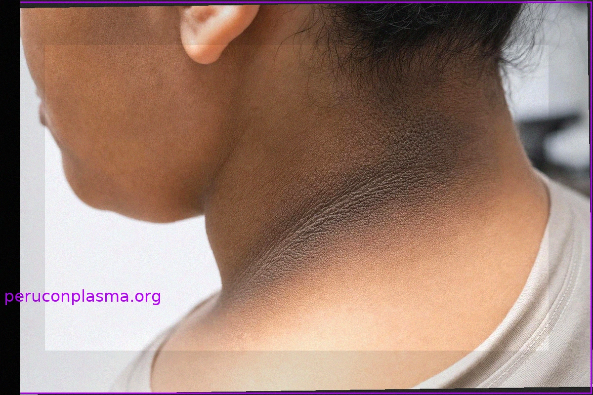 Acanthosis Nigricans: L'allarme della pelle scura sul collo